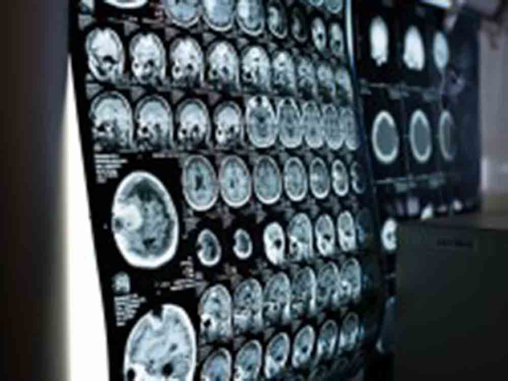 New MRI Study Reveals Covid 19's Impact on the Brain: Correlated ...